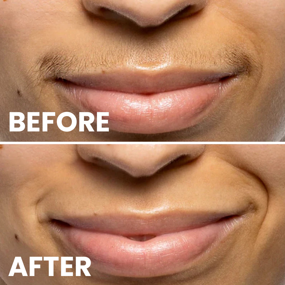 5MINSKIN AT-HOME LASER HAIR REMOVAL HANDSET - 72% OFF MOTHER'S DAY SALE + 4 FREE GIFTS (WORTH $290)