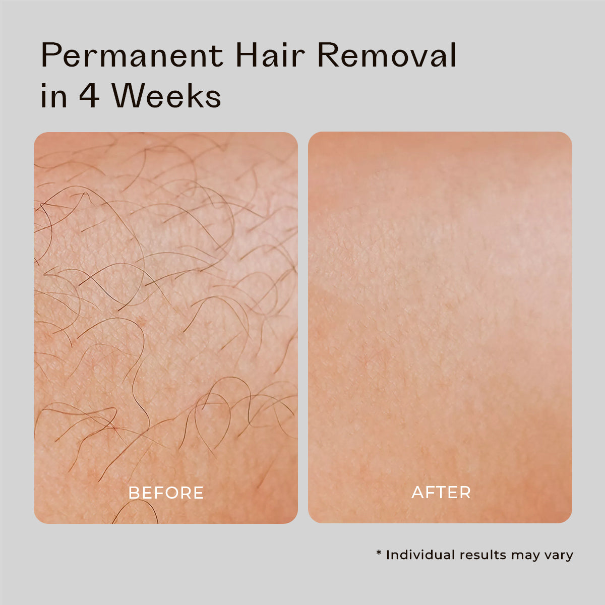 5MINSKIN AT-HOME LASER HAIR REMOVAL HANDSET - 50% OFF CHRISTMAS SALE