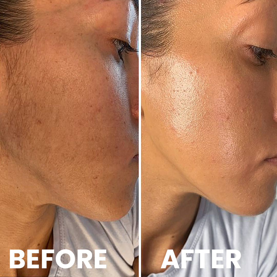 5MINSKIN AT-HOME LASER HAIR REMOVAL HANDSET - 72% OFF MOTHER'S DAY SALE + 4 FREE GIFTS (WORTH $290)