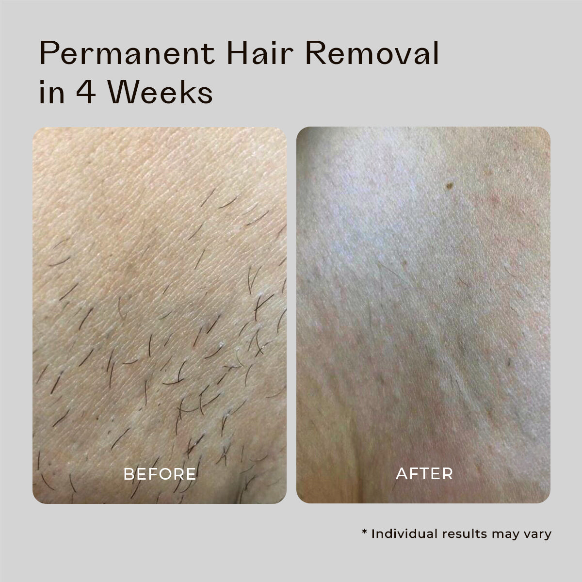 5MINSKIN AT-HOME LASER HAIR REMOVAL HANDSET - 50% OFF BLACK FRIDAY SALE