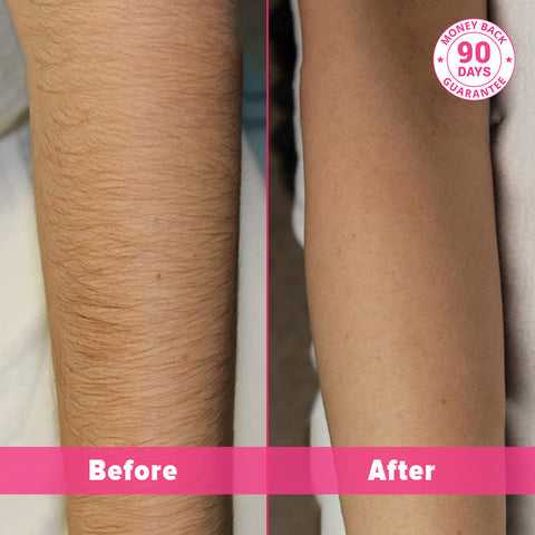 PAIN-FREE-AT-HOME LASER HAIR REMOVAL-HANDSET